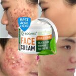 Effective Acne Removal Cream Herbal Acne Spots Oil Control Acne Cream Skin Care Whitening Moisturizing Face Gel Skin Care 50g