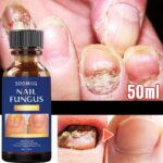 Nail Fungal Treatment Serum Onychomycosis Paronychia Anti Infection Toe Fungus Hand Foot Removal Repair Gel Care Beauty Health